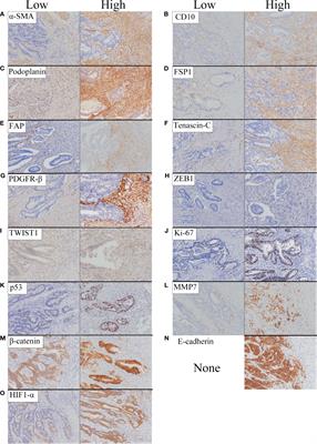 Expression Patterns of Microenvironmental Factors and Tenascin-C at the Invasive Front of Stage II and III Colorectal Cancer: Novel Tumor Prognostic Markers